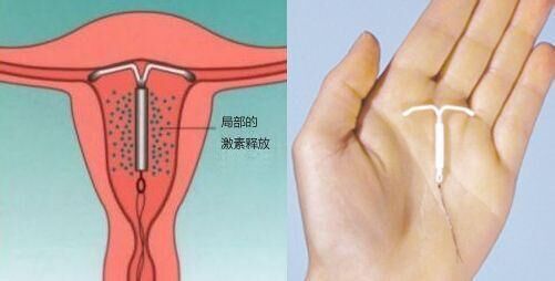 华阳女性做取环手术需要注意什么