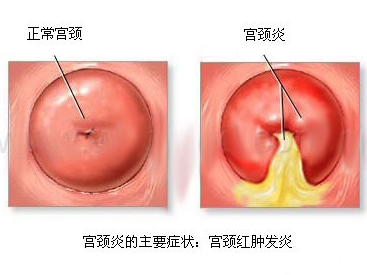 华阳哪里治疗宫颈炎会好点