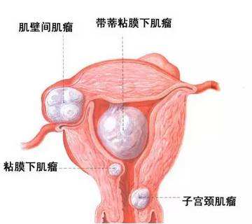 子宫肌瘤会带来什么危害?