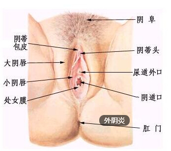 女性在生活中怎样预防外阴炎