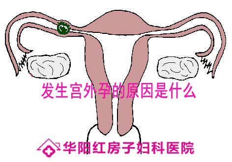 什么情况容易发生宫外孕